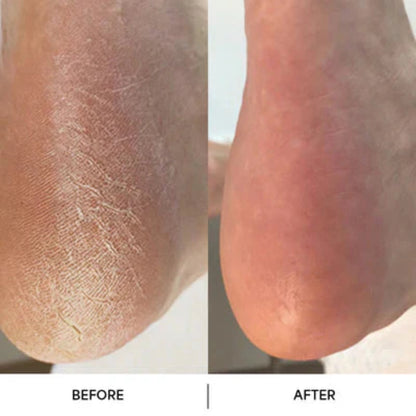 🏆Flash Sale⚡ The Original Callus Remover 2025 New Edition